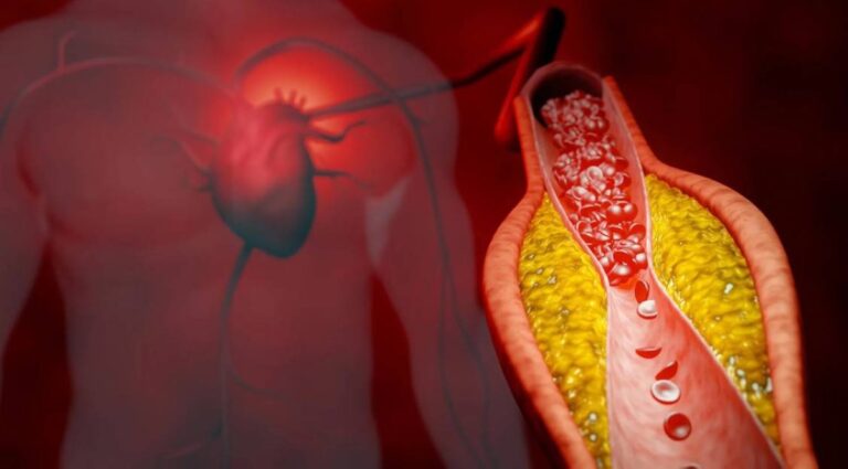 من دون آثار جانبية.. علاج جديد يخفض الكوليسترول 50%
