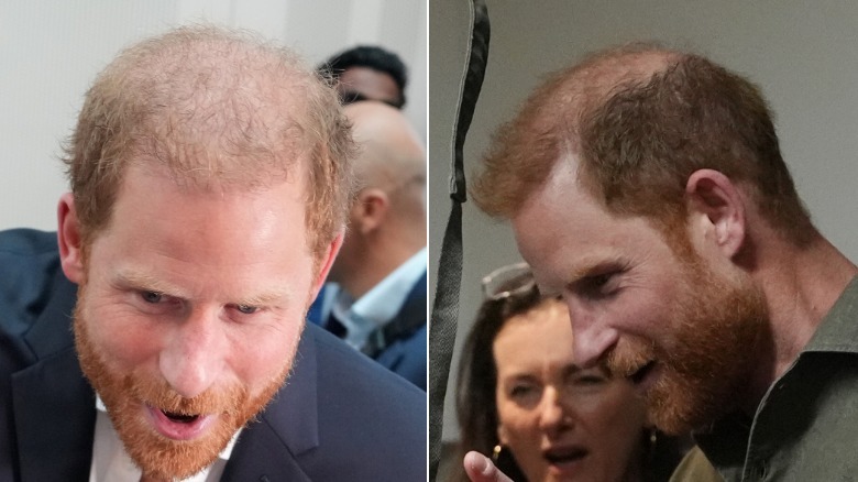 Prince Harry’s bald patch exposed in Australia.